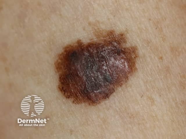 Melanoma dermoscopy example