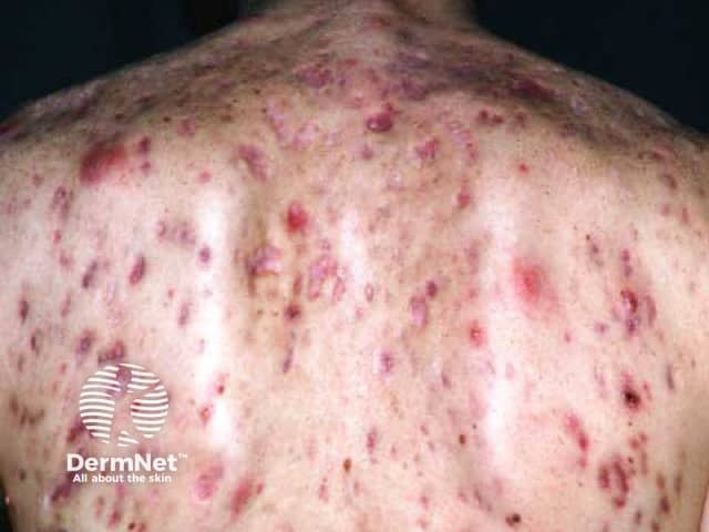 Nodulocystic acne example