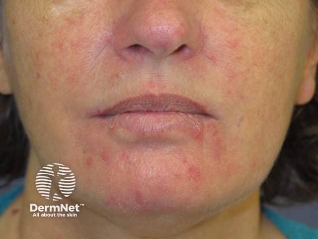 Rosacea example