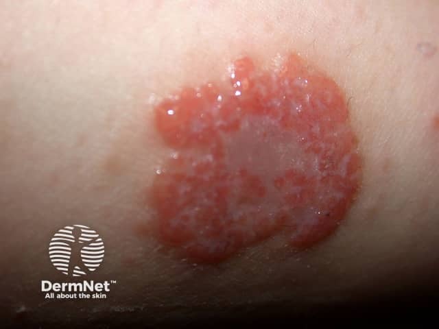 Eczema example